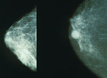 220px-Mammo_breast_cancer