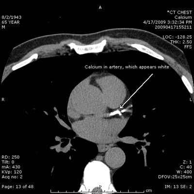 CT cardiac calcium 