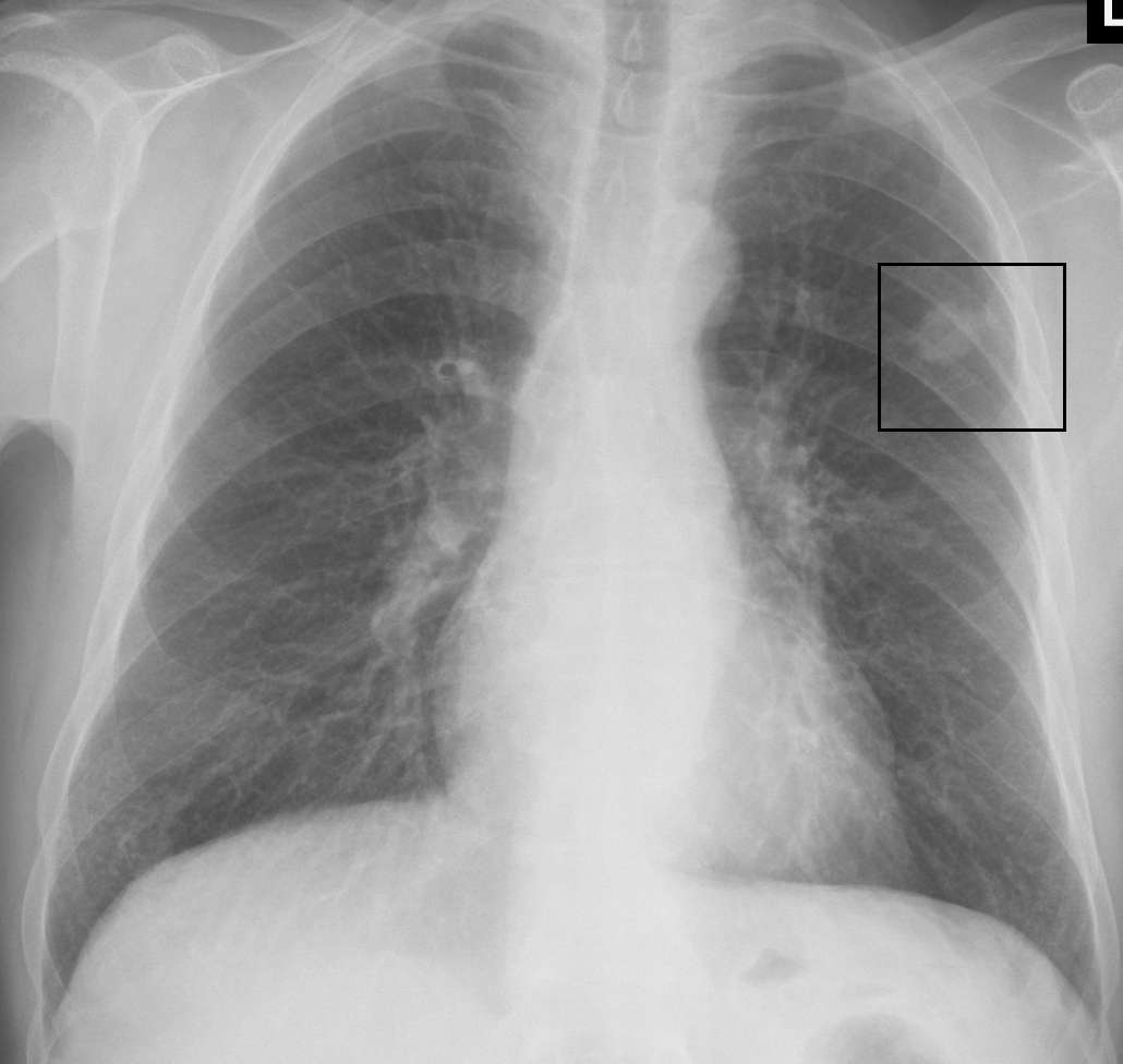 xray_lung_cancer