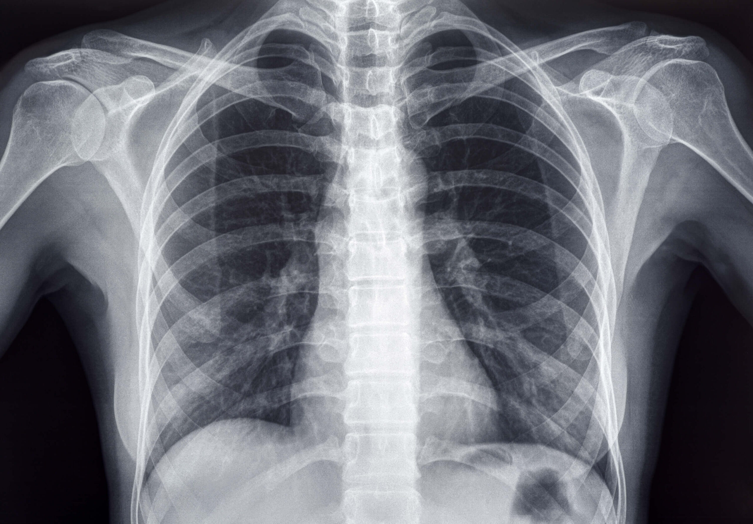 X-Ray lungs-and-ribs-xray-imaging