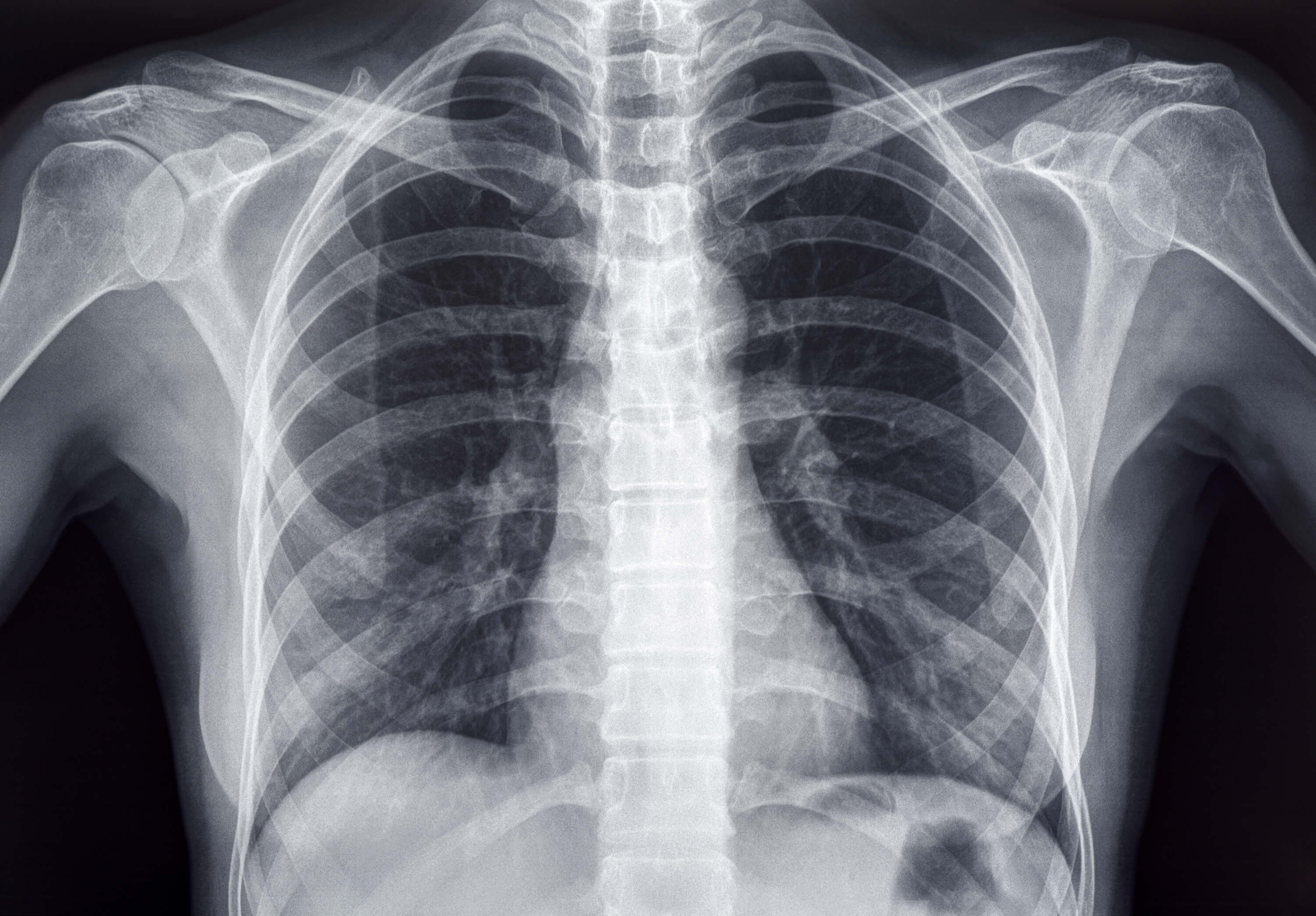X-Ray lungs-and-ribs-xray-imaging