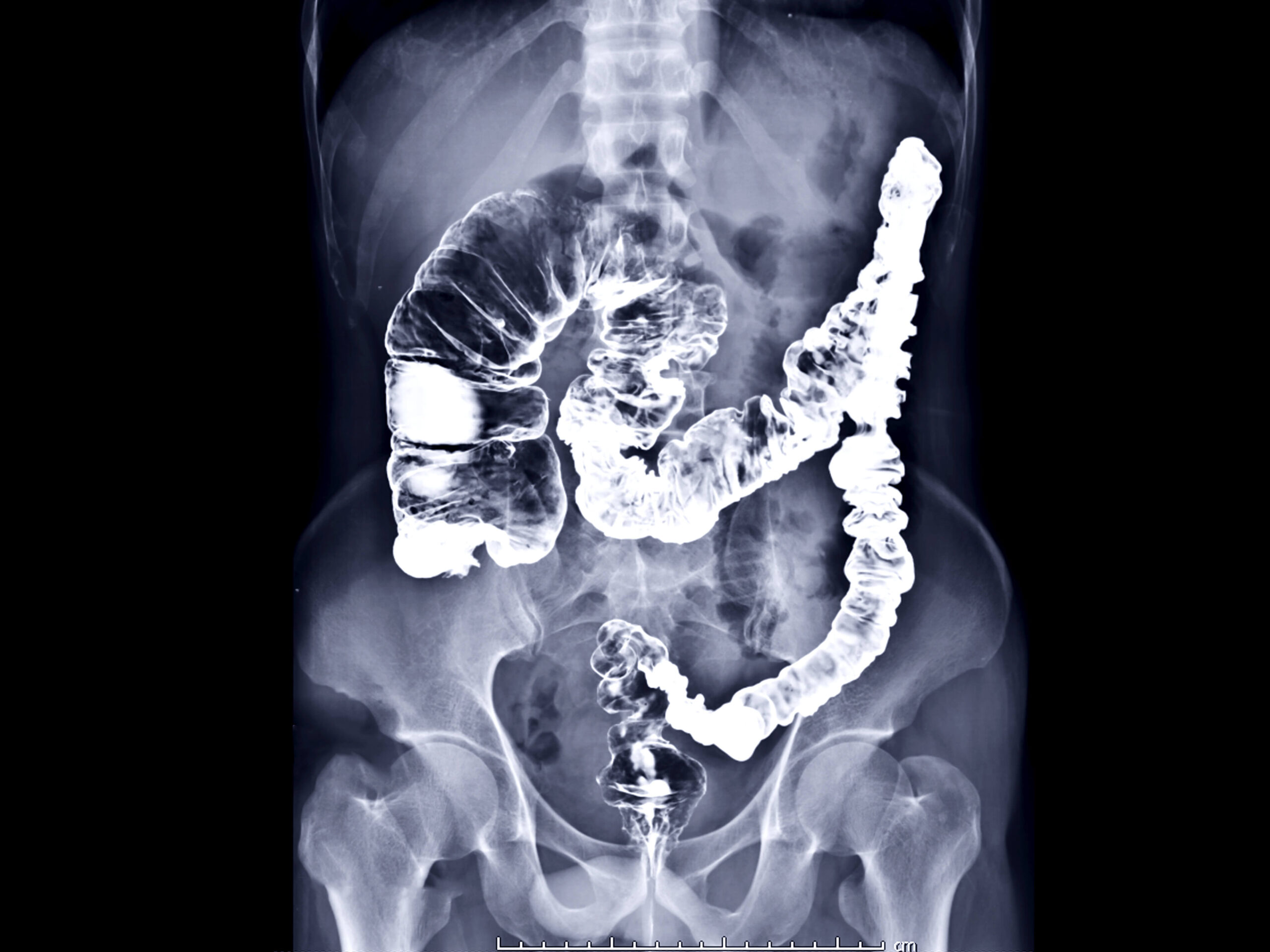 Fluoroscopy scan-of-intestines-with-fluoroscopy-treatment