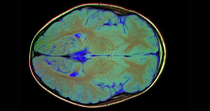 A brain MRI (also known as a head MRI) allows a radiologist to examine not only the brain itself but also the...